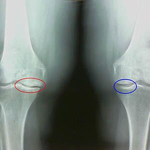 Arthrosis of the knee joint in radiography