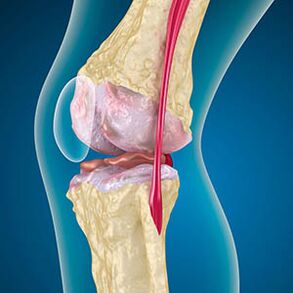 Excessive tension of the thigh muscles causing pain in the knee