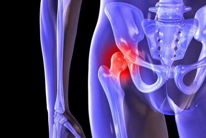 Pathological processes in the hip joint with coxarthrosis